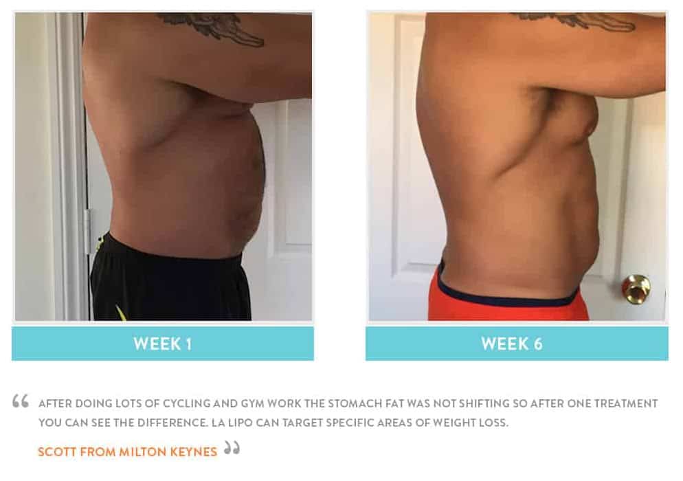 Before & After Stomach Fat Belsize Park