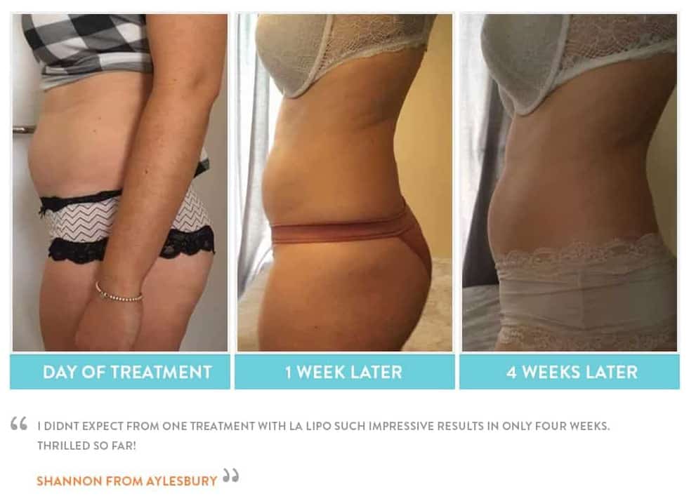 before, Cryolipolysis Belsize Park