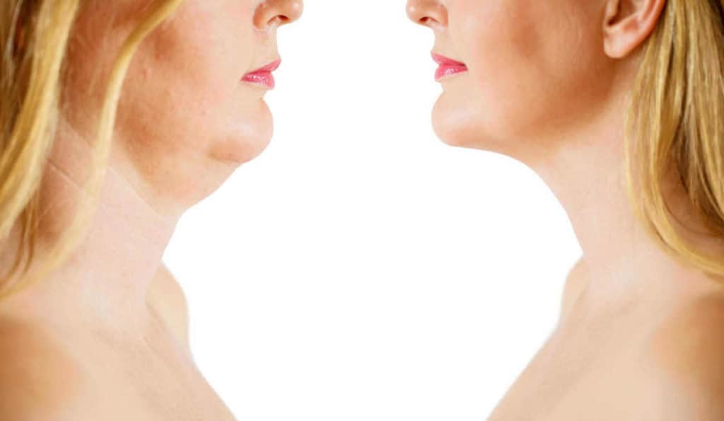 Double Chin treatment Belsize Park before and after results