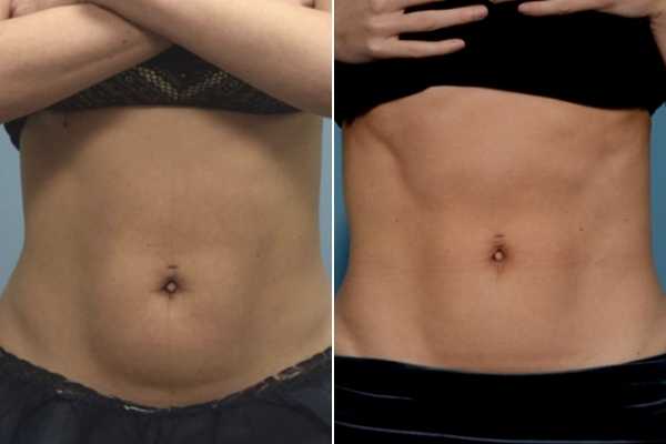 body sculpting FAQs Belsize Park