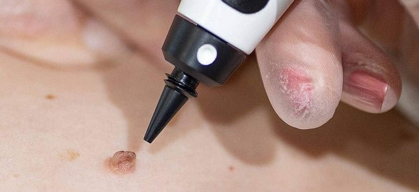 After Skin Tag Removal Belsize Park