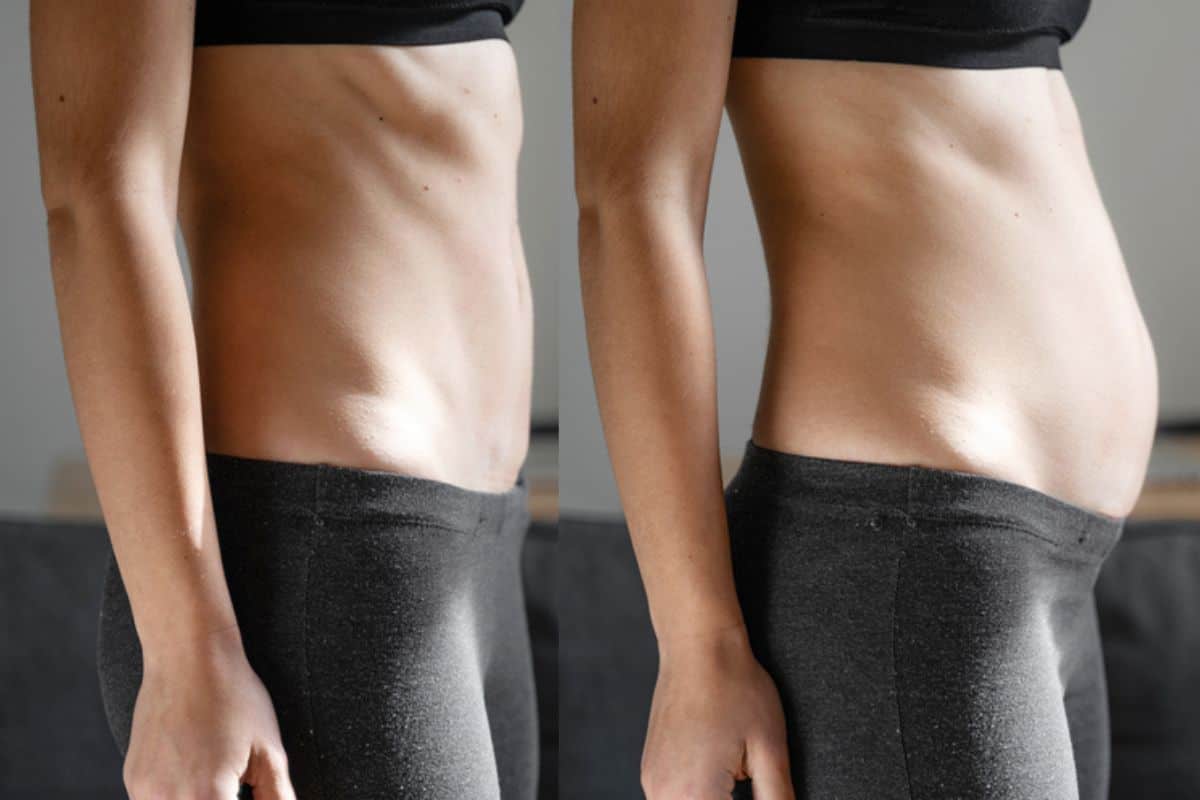 How long does diastasis recti take to improve Belsize Park?