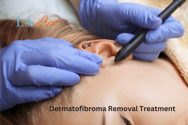 Dermatofibroma Removal Treatment Belsize Park