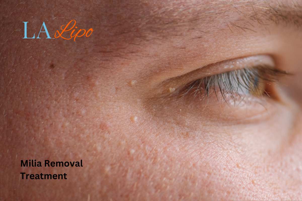 Cryopen Milia Removal: Is It the Easiest and Safest Option Belsize Park?