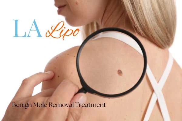 Why getting moles removed Belsize Park can boost your confidence!