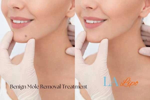 Woman's before and after results of being moles removal treatment Belsize Park