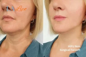 hi-fu for wrinkles Belsize Park before and after results