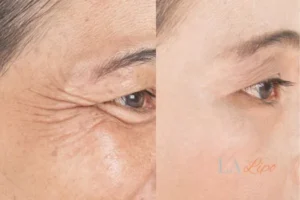 Before and after results of woman - HI-fu wrinkles reduction treatment Belsize Park