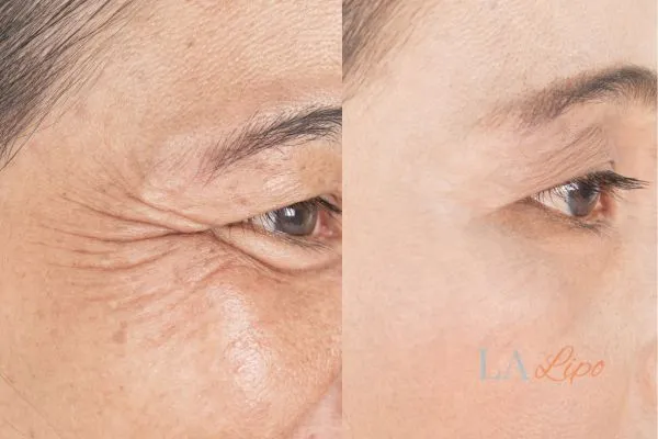 Before and after results of woman - HI-fu wrinkles reduction treatment Belsize Park