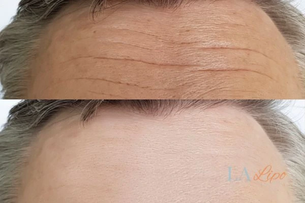 results of HIFU Belsize Park on mans forehead to help reduce lines and wrinkles