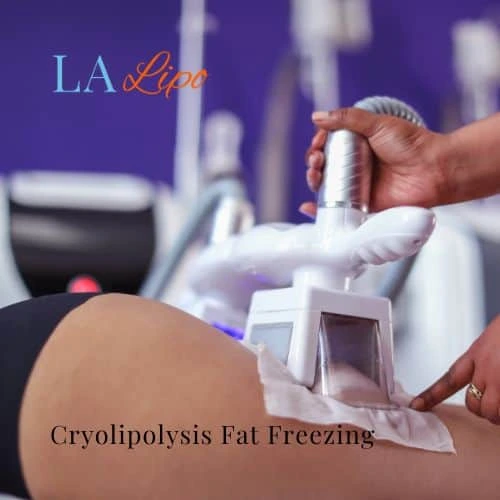fat freezing - Cryolipolysis Belsize Park