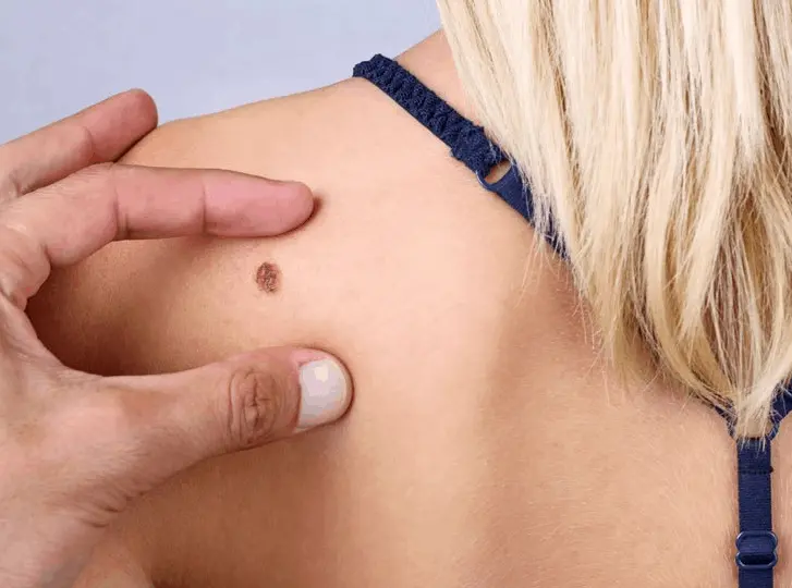 woman having mole removal Belsize Park consultation before treatment.