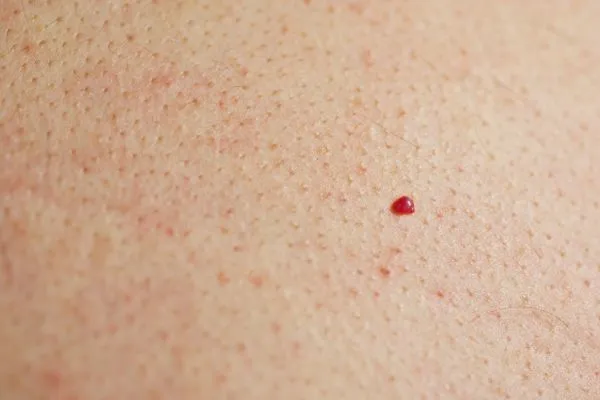 close up of a cherry angioma Belsize Park