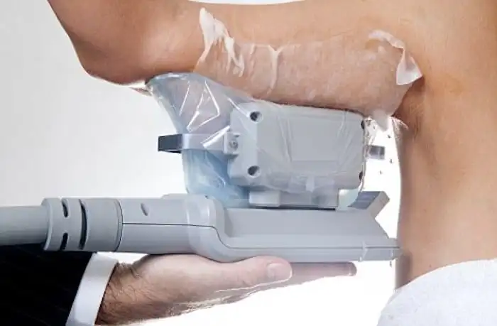 Picture of fat freezing Belsize Park on the upper arms.