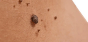 image of a skin tag Belsize Park
