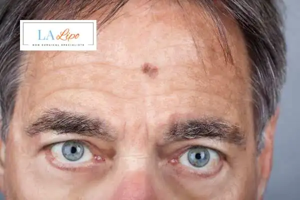 Solar Lentigo Removal Belsize Park image of man with mark on his forehead
