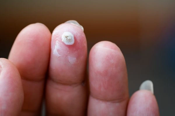 wart on person finger - cryotherapy to treat from LA LIPO Belsize Park
