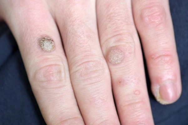 photo of warts on person hand - see wart removal Belsize Park from LA LIPO