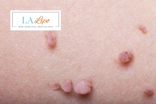 Does cryopen skin tag removal Belsize Park hurt? Find out now call our team today!