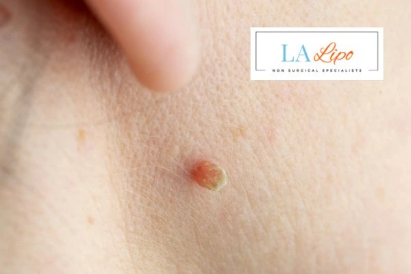 Book skin tag removal Belsize Park today speak to our team now!