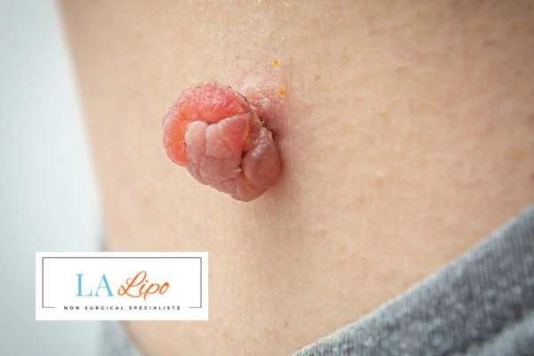 Interested in skin tag removal Belsize Park? Concerned about the pain? Find out more today!