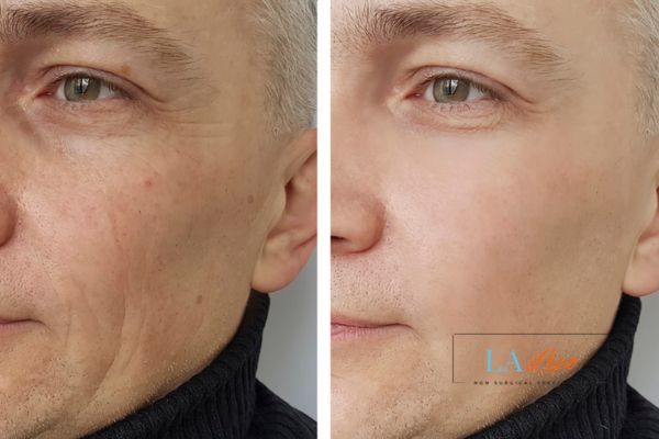See the amazing results of Morpheus8 Treatment Belsize Park!