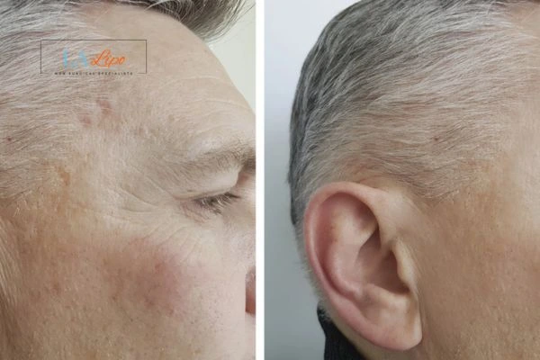 Mens Before & After Morpheus 8 Results Belsize Park