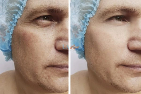 Before and after Morpheus 8 Results Belsize Park