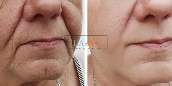Older lady deeper wrinkle reduction - LA LIPO Morpheus 8 Results Belsize Park