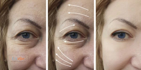 Amazing eye lift Morpheus 8 results Belsize Park
