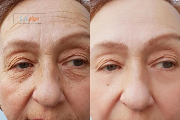 The powerful benefits of Morpheus8 Treatment Belsize Park - Call Our team today!