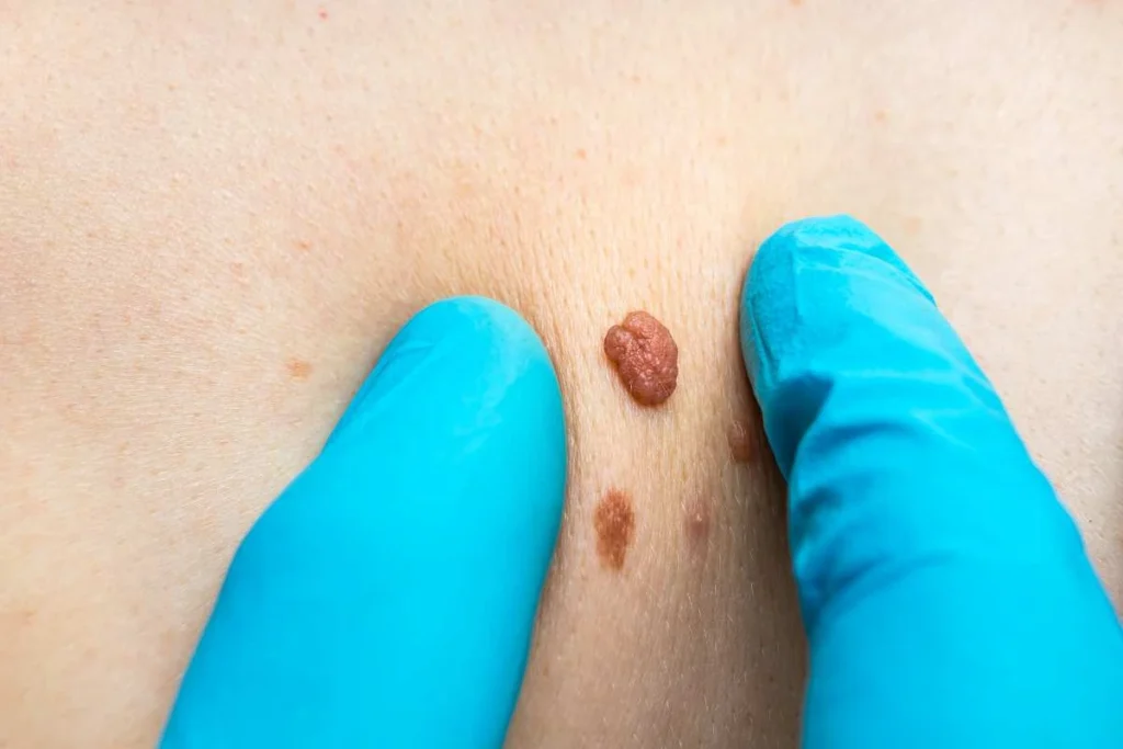 LA LIPO Cryopen Lesion Removal Prices Belsize Park