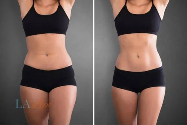 before and after results of non-surgical treatment to help a woman's body image and mental health Belsize Park
