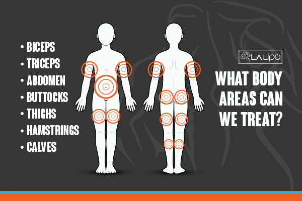 Diagram to show areas you can have LA-EMS Body Sculpting Treatment Belsize Park