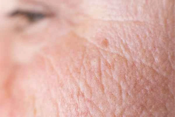 close up picture of a woman's face showing an age spot Belsize Park