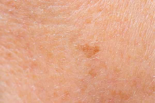 close up picture of age spots Belsize Park