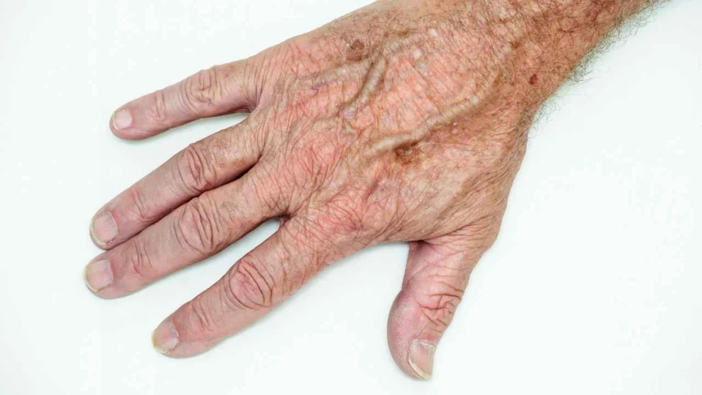 Male hand showing age spot Belsize Park