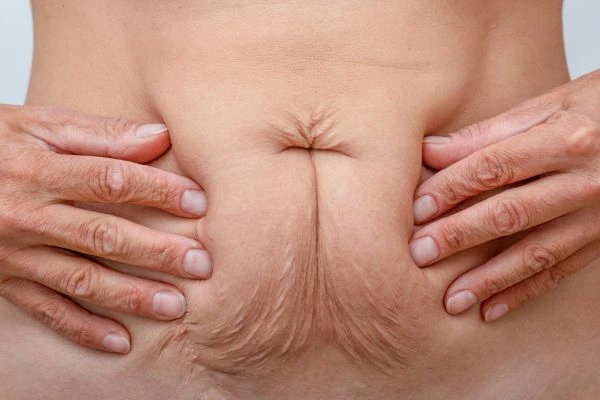 Image of a woman's stomach with loose skin - example of skin tightening Belsize Park options