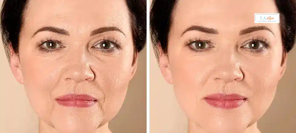 How Long Does It Take to See Results and How Long Do They Last Belsize Park?